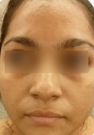 PRP Treatment for Face Before and after results at Dermatrix Clinic