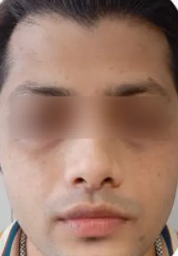 PRP Treatment for Face Before and after results at Dermatrix Clinic