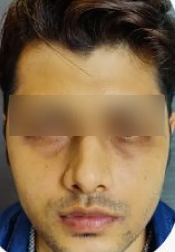 PRP Treatment for Face Before and after results at Dermatrix Clinic