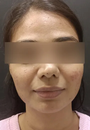 Chemical Peel Before and after results at Dermatrix Clinic