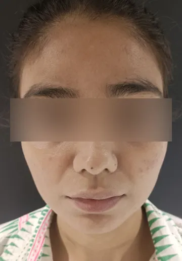 Chemical Peel Before and after results at Dermatrix Clinic