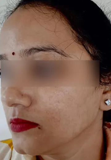 Acne Treatment Before and after results at Dermatrix Clinic