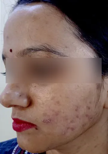 Acne Treatment Before and after results at Dermatrix Clinic