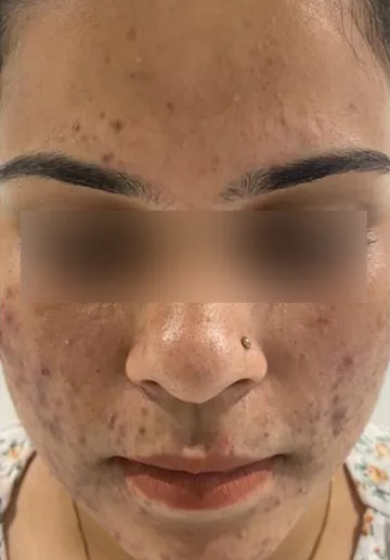 Acne Treatment Before and after results at Dermatrix Clinic