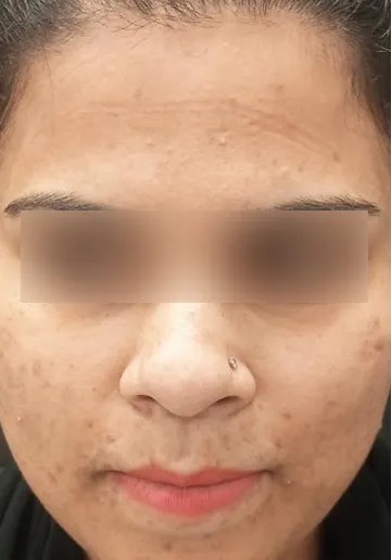 Acne Treatment Before and after results at Dermatrix Clinic