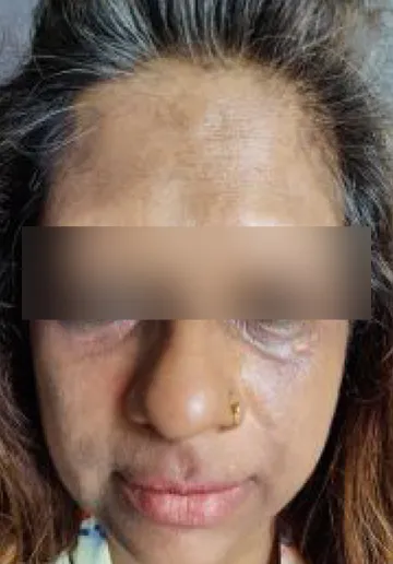 PRP Treatment for Face Before and after results at Dermatrix Clinic