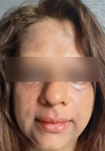 PRP Treatment for Face Before and after results at Dermatrix Clinic