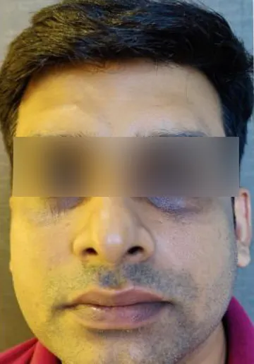 PRP Treatment for Face Before and after results at Dermatrix Clinic