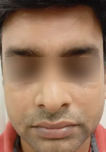 PRP Treatment for Face Before and after results at Dermatrix Clinic