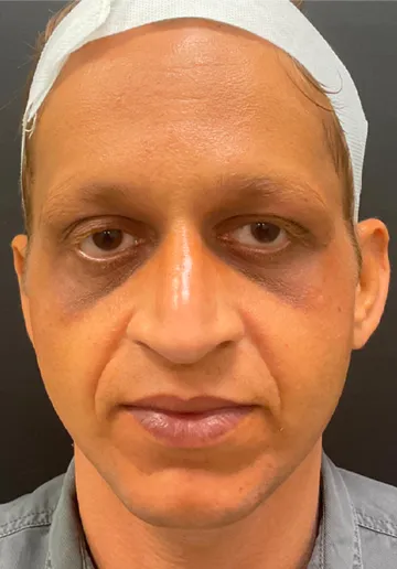 Thread Lifting Before and after results at Dermatrix Clinic