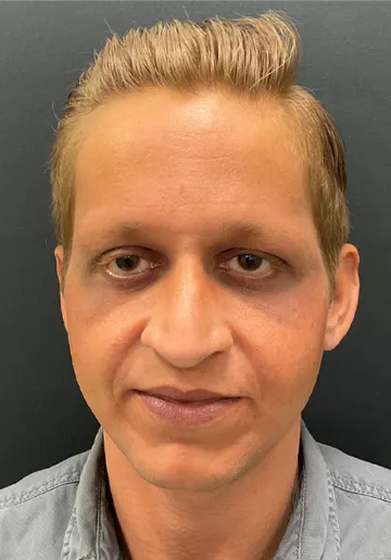 Thread Lifting Before and after results at Dermatrix Clinic