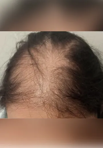 QR678 Treatment Before and after results at Dermatrix Clinic