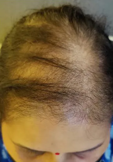 QR678 Treatment Before and after results at Dermatrix Clinic