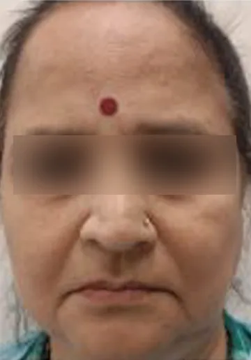 Thread Lifting Before and after results at Dermatrix Clinic