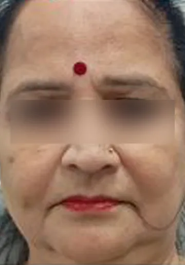 Thread Lifting Before and after results at Dermatrix Clinic