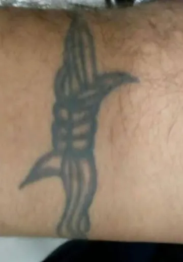 Tattoo Removal Before and after results at Dermatrix Clinic