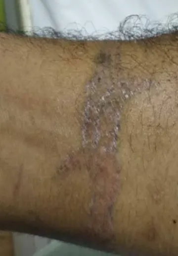 Tattoo Removal Before and after results at Dermatrix Clinic