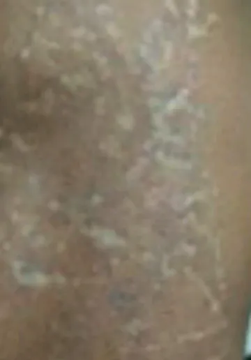 Tattoo Removal Before and after results at Dermatrix Clinic