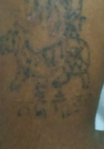 Tattoo Removal Before and after results at Dermatrix Clinic