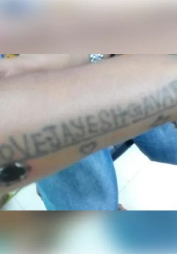 Tattoo Removal Before and after results at Dermatrix Clinic
