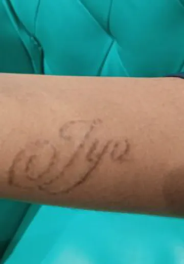 Tattoo Removal Before and after results at Dermatrix Clinic