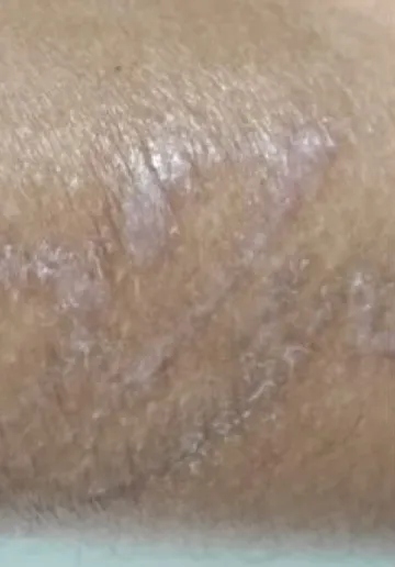 Tattoo Removal Before and after results at Dermatrix Clinic