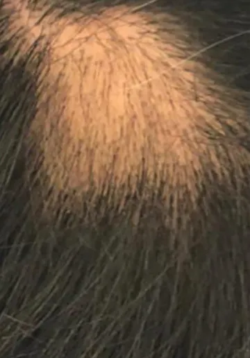 Alopecia Treatment Before and after results at Dermatrix Clinic