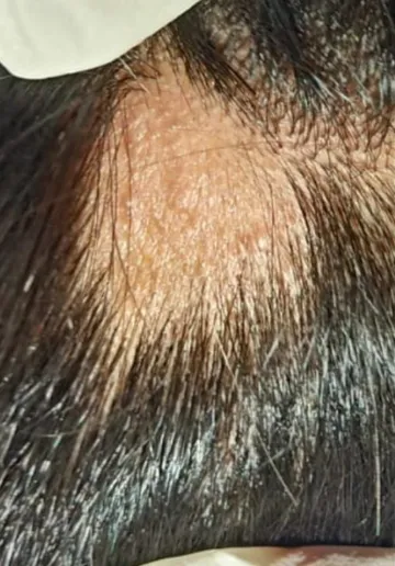Alopecia Treatment Before and after results at Dermatrix Clinic