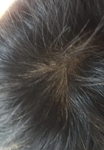 Alopecia Treatment Before and after results at Dermatrix Clinic
