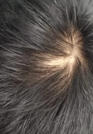 Alopecia Treatment Before and after results at Dermatrix Clinic