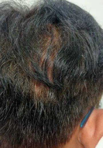 Alopecia Treatment Before and after results at Dermatrix Clinic