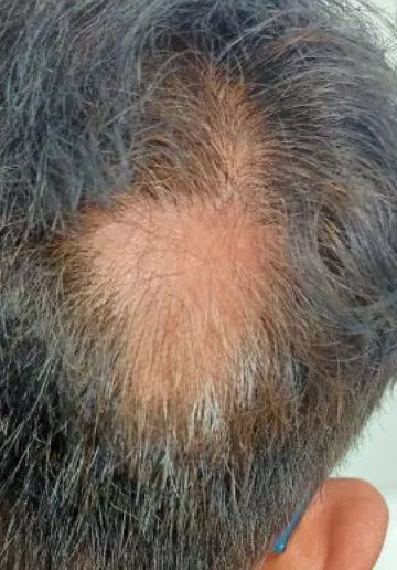 Alopecia Treatment Before and after results at Dermatrix Clinic