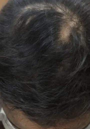 Alopecia Treatment Before and after results at Dermatrix Clinic