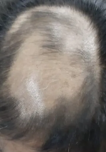 Alopecia Treatment Before and after results at Dermatrix Clinic
