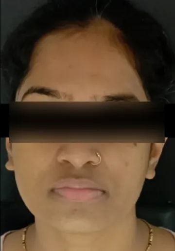 Chemical Peel Before and after results at Dermatrix Clinic