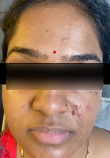Chemical Peel Before and after results at Dermatrix Clinic