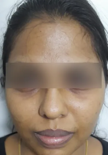 Chemical Peel Before and after results at Dermatrix Clinic