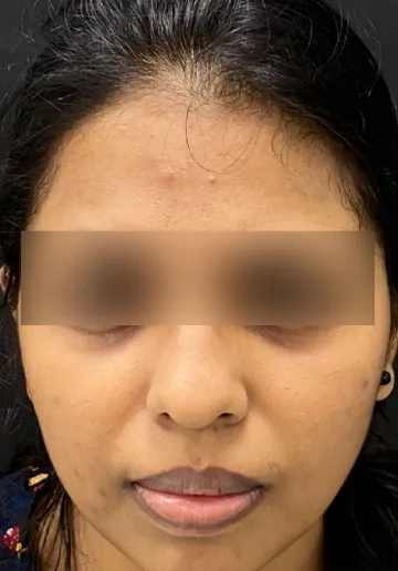 Chemical Peel Before and after results at Dermatrix Clinic