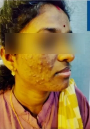 Acne Treatment Before and after results at Dermatrix Clinic