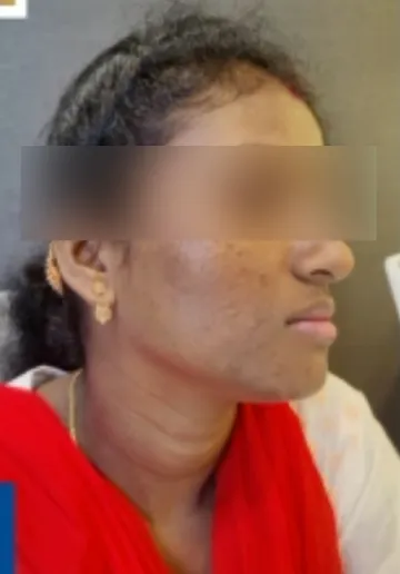 Acne Treatment Before and after results at Dermatrix Clinic