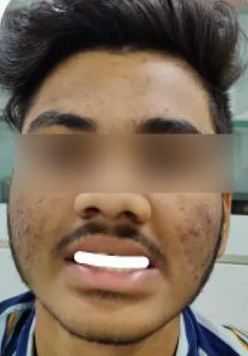 Chemical Peel Before and after results at Dermatrix Clinic