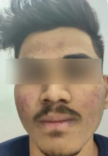 Chemical Peel Before and after results at Dermatrix Clinic