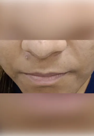 Mole Removal Before and after results at Dermatrix Clinic