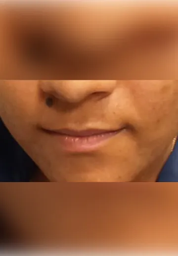 Mole Removal Before and after results at Dermatrix Clinic