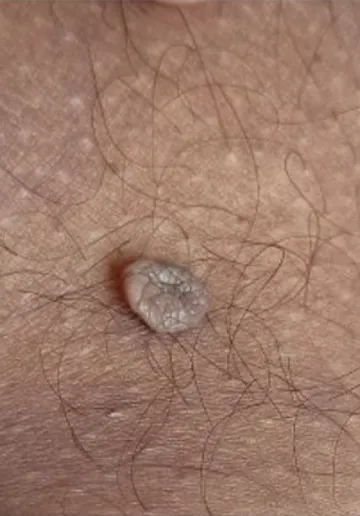 Mole Removal Before and after results at Dermatrix Clinic