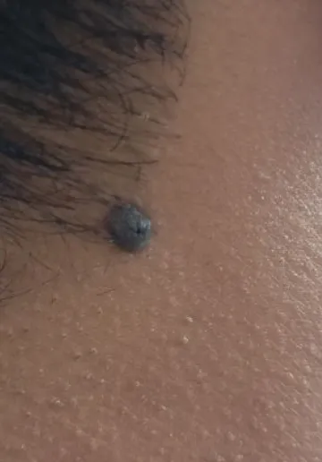 Mole Removal Before and after results at Dermatrix Clinic