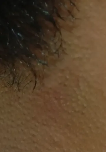Mole Removal Before and after results at Dermatrix Clinic