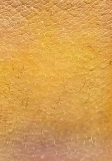 Mole Removal Before and after results at Dermatrix Clinic