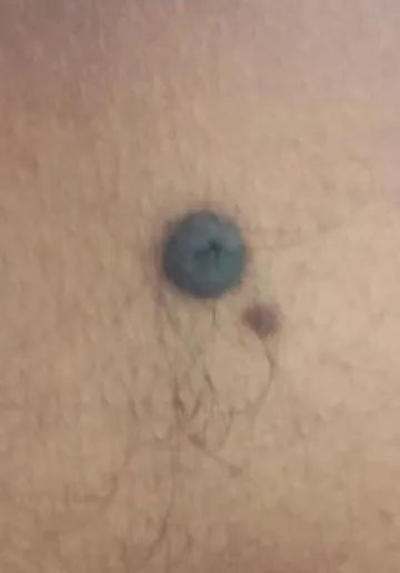 Mole Removal Before and after results at Dermatrix Clinic