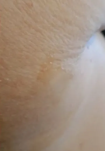 Mole Removal Before and after results at Dermatrix Clinic